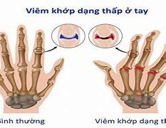 Cách Điều Trị Viêm Khớp Dạng Thấp Bằng Thuốc Nam